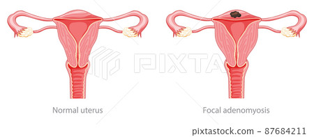 Focal Adenomyosis Human anatomy Female Sick and normal reproductive system organs. Location scheme Cross section icon Focal Adenomyosis Human anatomy Female Sick and normal reproductive system organs. Location scheme Cross section icon 87684211