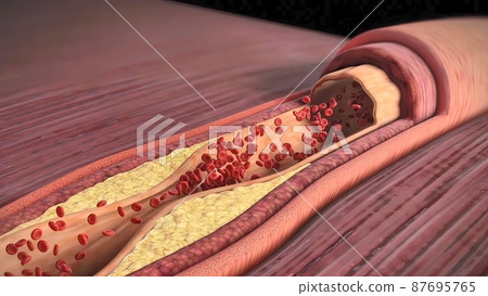 cholesterol plaque, atherosclerosis and heart attack cholesterol plaque, atherosclerosis and heart attack 87695765