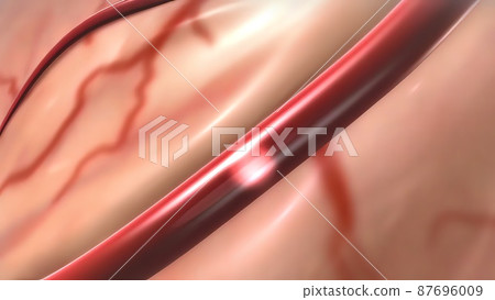 Acute Coronary Syndrome and Heart Attack 87696009