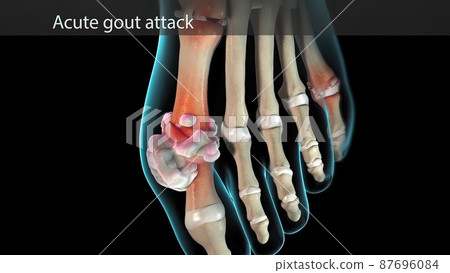 Acute gout atack 87696084