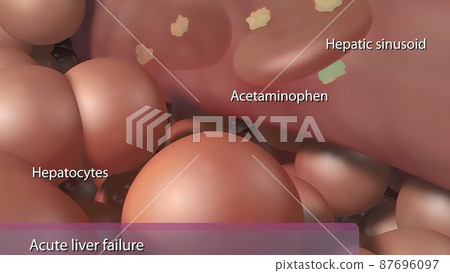 Cytokine release due to acute liver failure 87696097