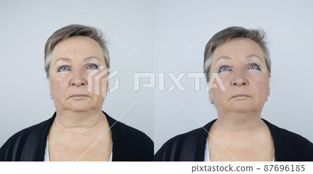 Second chin lift in senior woman. Photos before and after plastic surgery, mentoplasty or facebuilding. Chin fat removal and face contour correction. Face lifting from elderly female Second chin lift in senior woman. Photos before and after plastic surgery, mentoplasty or facebuilding. Chin fat removal and face contour correction. Face lifting from elderly female 87696185