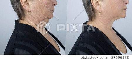 Photos before and after plastic surgery to remove Venus rings. Contour plastics of the neck, mesotherapy or botulinum therapy. Wrinkles and creases in the neck Photos before and after plastic surgery to remove Venus rings. Contour plastics of the neck, mesotherapy or botulinum therapy. Wrinkles and creases in the neck 87696188