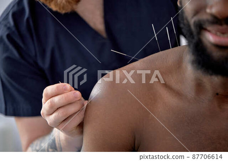 acupuncture therapy on back spine shoulders for black male client, close-up part of body 87706614