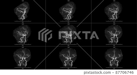 健康的頸動脈 87706746