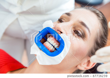 Female patient undergoing teeth whitening procedure 87716239