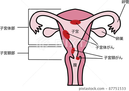 子宮 / 癌症插圖 子宮 / 癌症插圖 87751533