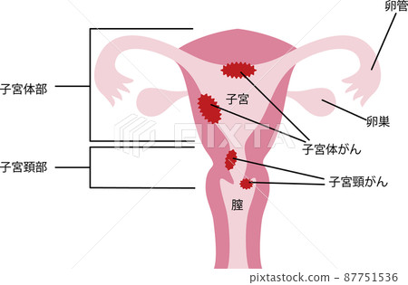 子宮 / 癌症插圖 子宮 / 癌症插圖 87751536