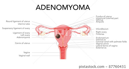 Adenomyoma Adenomyosis with inscriptions, Human anatomy Female reproductive Sick system organs. Structure of uterus Adenomyoma Adenomyosis with inscriptions, Human anatomy Female reproductive Sick system organs. Structure of uterus 87760431