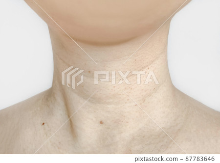 頸部因衰老而出現的皺紋和腫塊 頸部因衰老而出現的皺紋和腫塊 87783646
