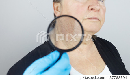 Rosacea on the skin of an old woman. Close-up of a capillary network. Redness on the skin. Problems with the outflow of blood in the capillaries. Doctor examines the problems of the patient Rosacea on the skin of an old woman. Close-up of a capillary network. Redness on the skin. Problems with the outflow of blood in the capillaries. Doctor examines the problems of the patient 87788794