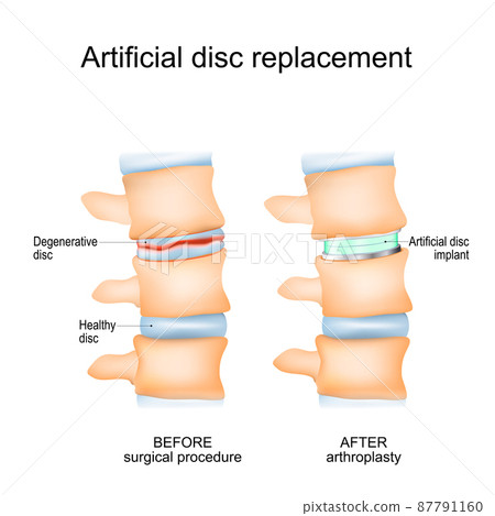 Intervertebral disc arthroplasty Intervertebral disc arthroplasty 87791160
