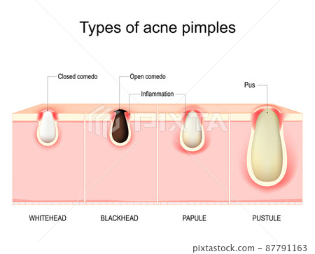 Types of acne pimples. Cross section of human Skin Types of acne pimples. Cross section of human Skin 87791163