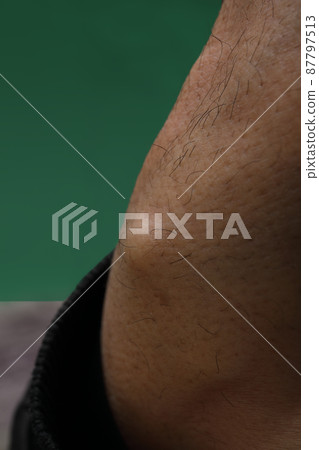 Before treatment of ganglion Before treatment of ganglion 87797513