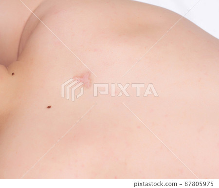 Scar on a man's back after removal of an inflamed boil, scar, close-up, copy space, healthcare Scar on a man's back after removal of an inflamed boil, scar, close-up, copy space, healthcare 87805975