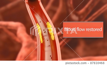 Atherosclerosis, plaque buildup and thickening of the arteries in the inner lining of an artery 3D medical illustration 87810468