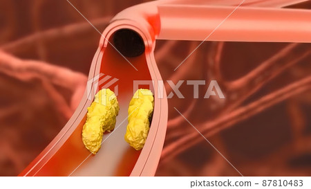 Atherosclerosis, plaque buildup and thickening of the arteries in the inner lining of an artery 3D medical illustration 87810483