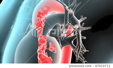 3D medical illustration of pulsatile Abdominal Aortic Aneurysm 3D medical illustration of pulsatile Abdominal Aortic Aneurysm 87810713