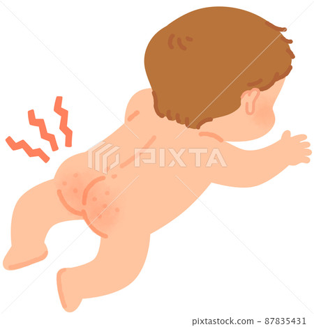 Baby with eczema on the buttocks 87835431