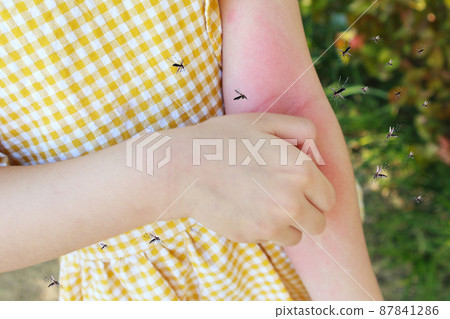 Little girl has skin rash allergy and itchy on her arm from mosquito bite Little girl has skin rash allergy and itchy on her arm from mosquito bite 87841286