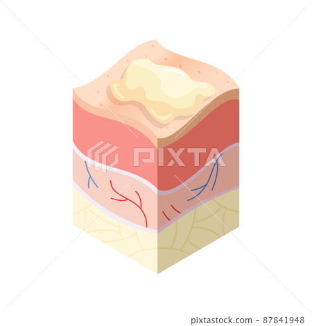 Skincare medical concept. Problems in cross-section of human skin horizontal layers structure. Anatomy illustrative model Skincare medical concept. Problems in cross-section of human skin horizontal layers structure. Anatomy illustrative model 87841948