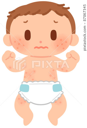 Baby with eczema on the body - Stock Illustration [87867345] - PIXTA