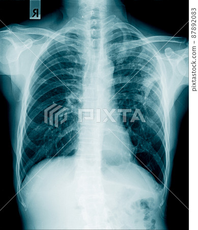 x-ray image of human abdomen, picture of human spine x-ray image of human abdomen, picture of human spine 87892083
