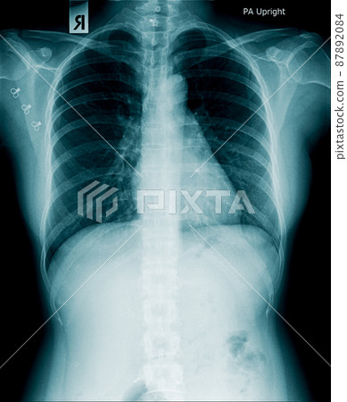 x-ray image of human abdomen, picture of human spine x-ray image of human abdomen, picture of human spine 87892084