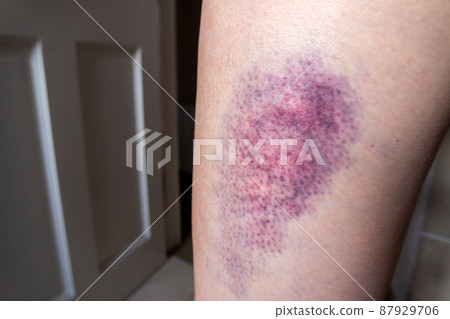 Terrible bruise on the upper leg of a woman 87929706