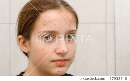 face of a teenage girl with pimples, acne on the skin, portrait of puberty girl face of a teenage girl with pimples, acne on the skin, portrait of puberty girl 87932546