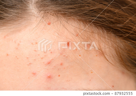 face of a teenage girl with pimples, acne on the forehead skin, portrait face of a teenage girl with pimples, acne on the forehead skin, portrait 87932555