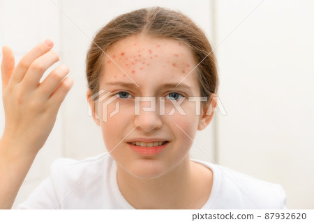 a disappointed teenage girl looks in the mirror at her face with pimples, touches her face, she is upset and has bad emotions 87932620