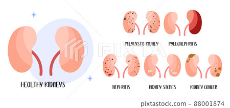 Kidneys diseases. Polycystic kidney, pyelonephritis, nephritis, stones, cancer. Urology. Vector flat illustration. Perfect for flyer, medical brochure, banner, landing page, website Kidneys diseases. Polycystic kidney, pyelonephritis, nephritis, stones, cancer. Urology. Vector flat illustration. Perfect for flyer, medical brochure, banner, landing page, website 88001874