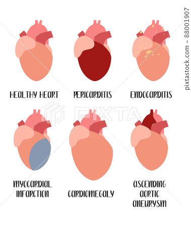 Heart, cardiovascular diseases. Pericarditis, endocarditis, myocardial infarction, cardiomegaly, aneurysm. Cardiology. Vector flat illustration. For flyer, medical brochure, banner, landing page, 88001907