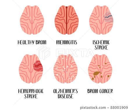 Brain diseases. Meningitis, ischemic and hemorrhagic stroke, alzheimer's disease, cancer. Neurobiology. Vector flat illustration. Perfect for flyer, medical brochure, banner, landing page, website 88001909