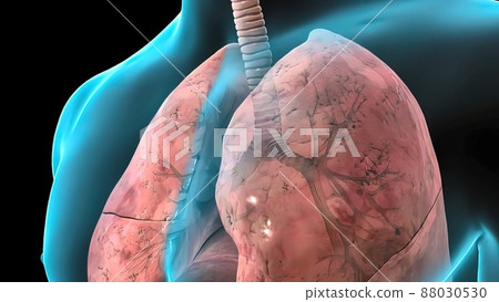 Damaged sick lungs. 3D render illustration for respiratory problems, cancer medical or health problems. 88030530