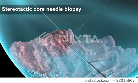 Breast cancer Girl with breast pathology. . Illustration and close-up of female human structure. Breast cancer Girl with breast pathology. . Illustration and close-up of female human structure. 88030602