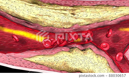 Coronary atherosclerosis, light micrograph showing cholesterol-containing plaque 88030657