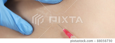 Doctor injecting medication in area of postoperative scar on skin closeup 88038730