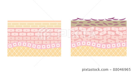 Cross section of the skin. An illustration showing a comparison between healthy skin and rough skin. 88046965