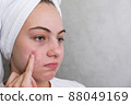 teenage girl. Acne. Problematic skin. Facial skin care. 88049169