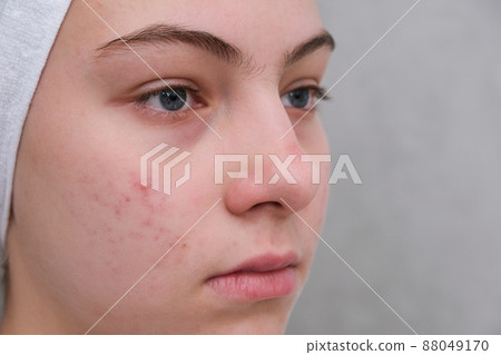 Acne. Teenage girl with the pimples on her face. Problematic skin. Close-up. 88049170