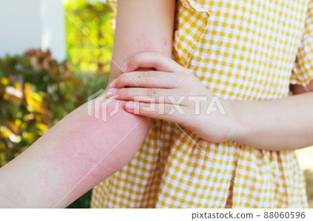 Little girl has skin rash allergy and itchy on her arm 88060596