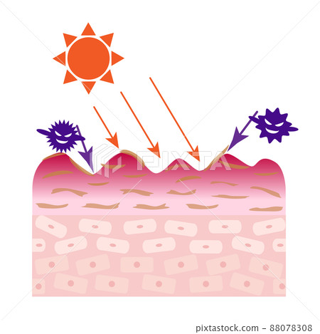粗糙皮膚的橫截面。由紫外線引起的污漬的圖像。 88078308