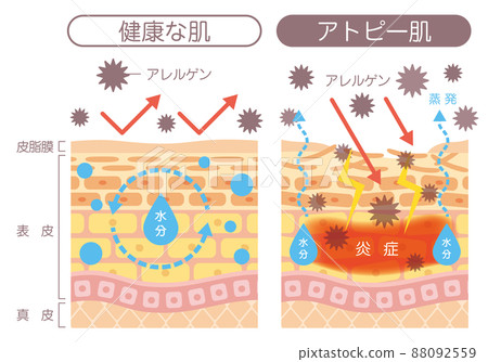 Skin structure_atopic skin 88092559