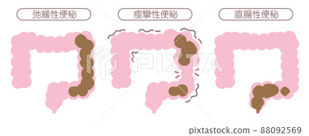 便秘的類型 88092569