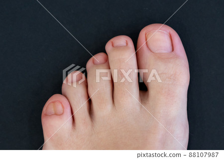 Female feet with big double little toe on black background 88107987