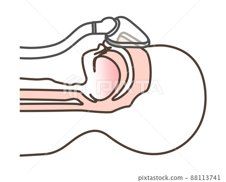 Illustration of CPAP 88113741