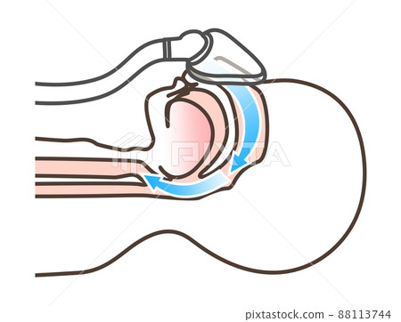 Illustration of CPAP Illustration of CPAP 88113744