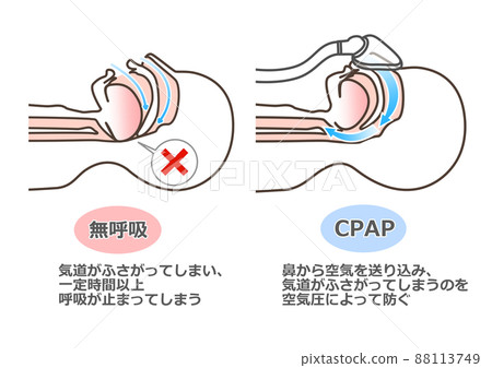 Illustration of CPAP 88113749